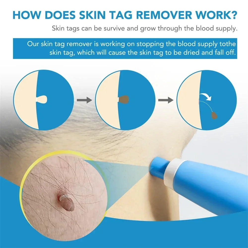 2 IN 1 Auto Micro Skin Tag Remover Device Skin Tag Removal Kit
