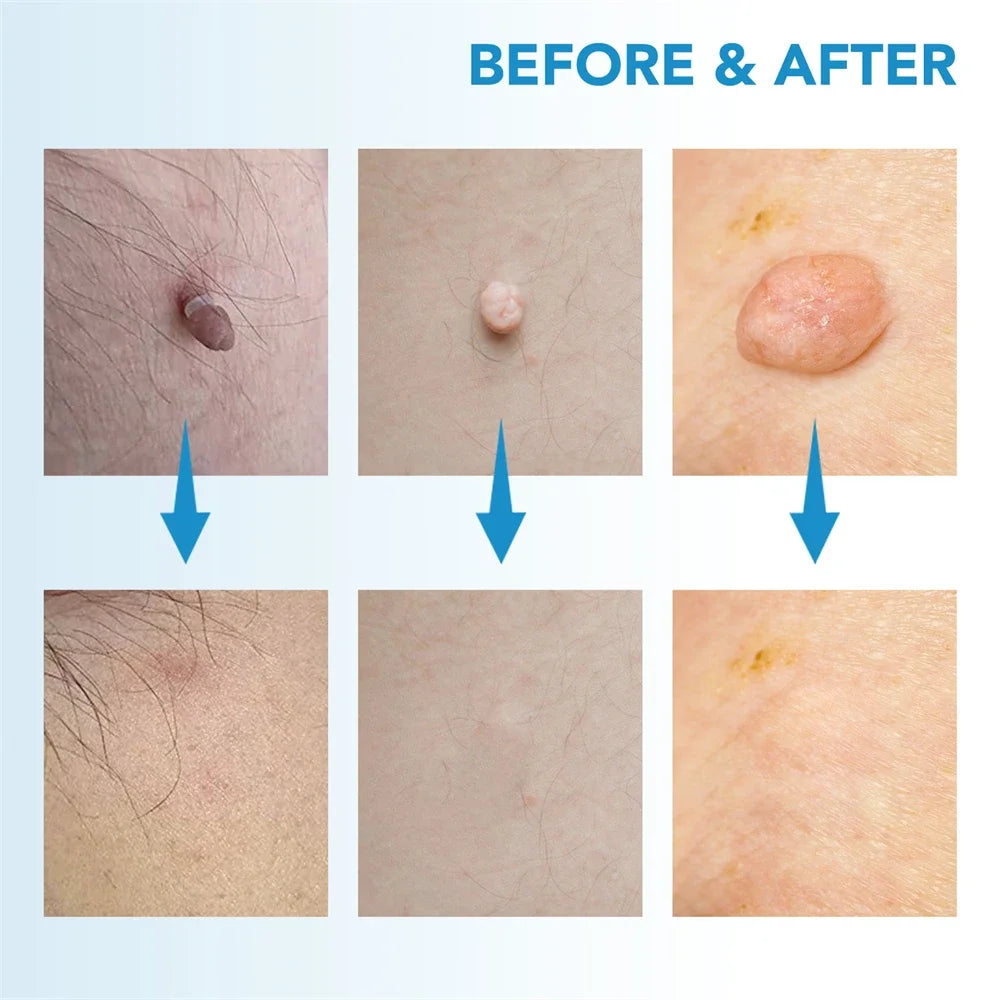 2 IN 1 Auto Micro Skin Tag Remover Device Skin Tag Removal Kit