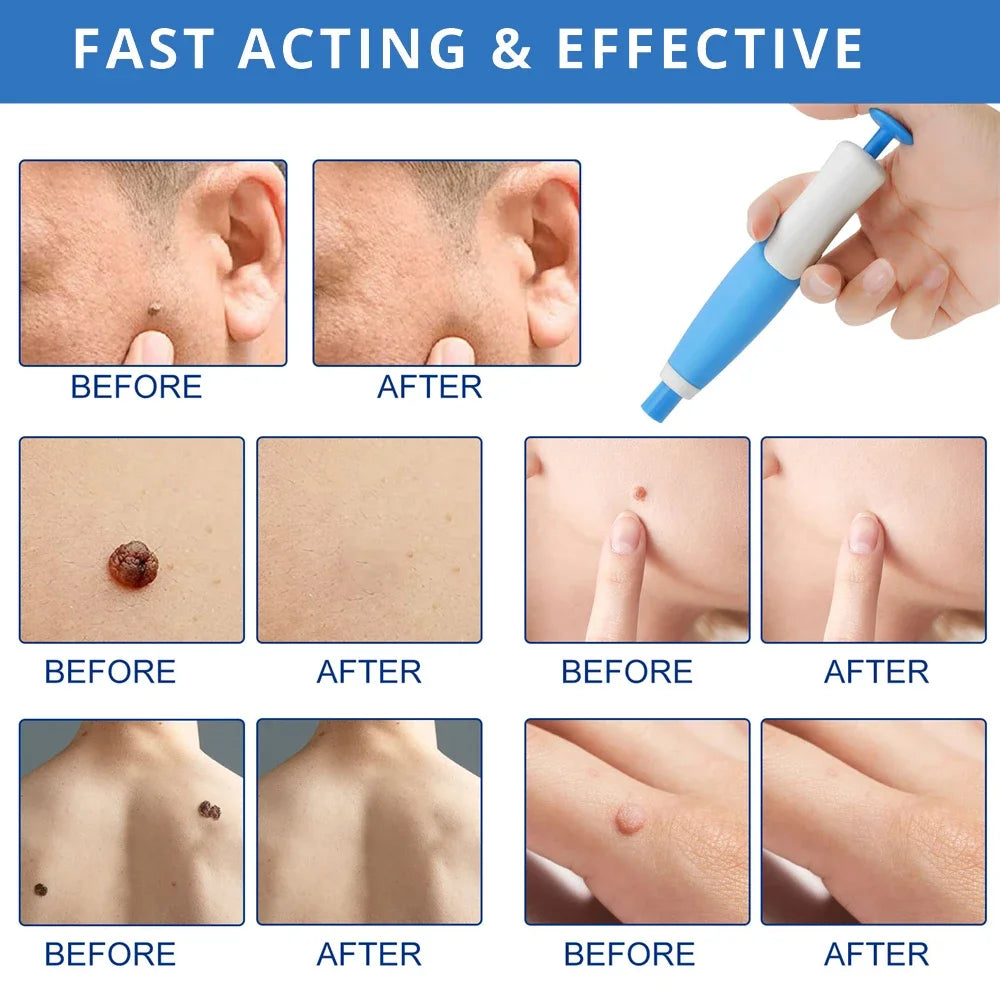 2 IN 1 Auto Micro Skin Tag Remover Device Skin Tag Removal Kit