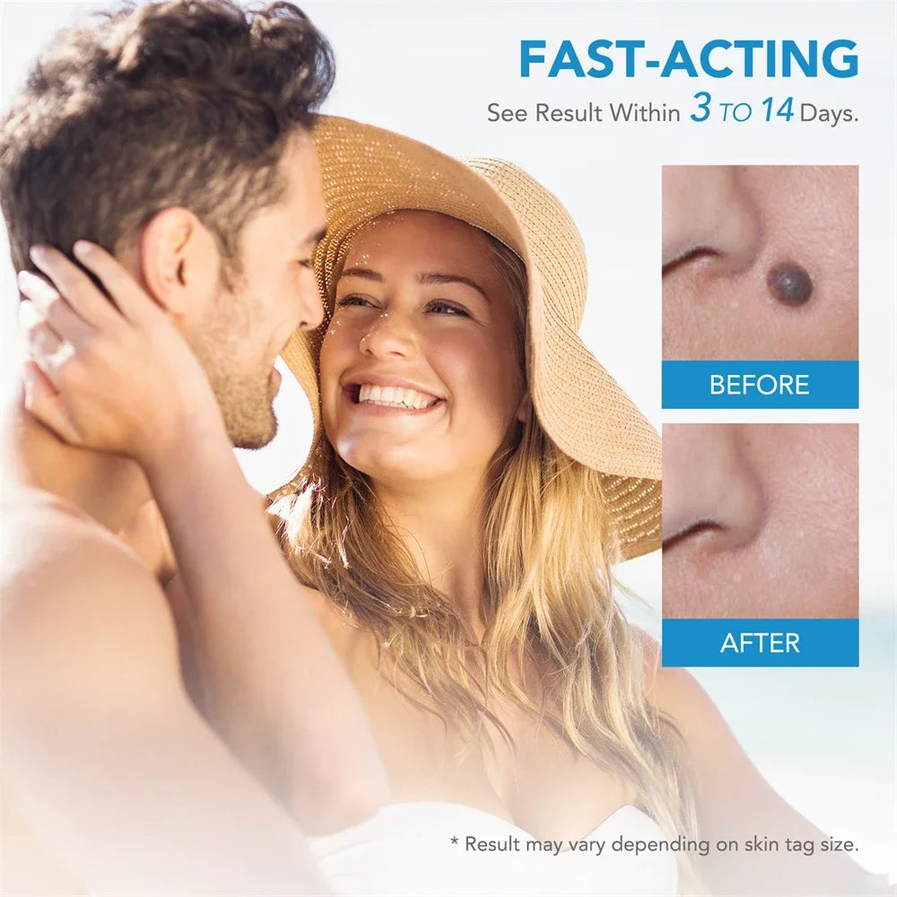 2 IN 1 Auto Micro Skin Tag Remover Device Skin Tag Removal Kit